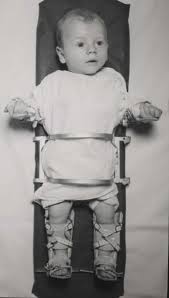 Polio, Baby, Bradford frame images